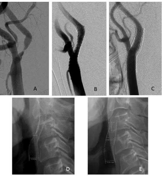 Fig. 6   CAG and plain cervical XP of Case 1. (A) Initial CAG, (B) CAG immediately after CAS, (C) CAG  18 months after CAS, (D) XP immediately after CAS, and (E) XP 18 months after CAS