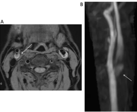Fig. 7   MRI and MRA of the Case 2. (A) Black-blood plaque imaging of the plaque showed high intensity  (arrow)  and  its  plaque/muscle  signal  intensity  ratio  was  1.65
