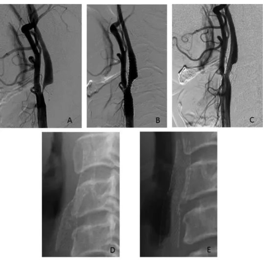 Fig. 8   CAG and plain cervical XP of Case 2. (A) Initial CAG, (B) CAG immediately after CAS, (C) CAG  12 months after CAS, (D) XP immediately after CAS, and (E) XP 12 months after CAS