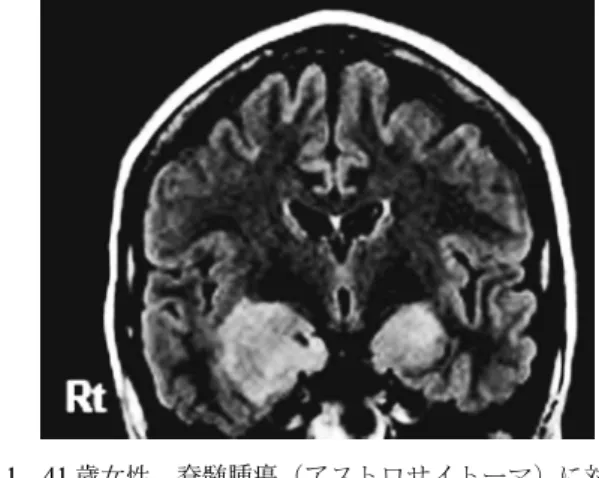 図 1 41 歳女性，脊髄腫瘍（アストロサイトーマ）に対して 髄内播種予防目的に脊髄離断術を施行した 5 カ月後に 辺縁系脳炎を発症した．頭部 MRI T2 強調像で両側大 脳側頭葉に高信号域を認める 25) ．SLESLE と辺縁系脳炎の関連では抗 dsDNA 抗体が Glue2 と交差反応性を有することから，自己抗体により神経細胞の NMDA 受容体の傷害が生じ，神経細胞のアポトーシスに寄与する可能性がある．Sj äogren 症候群Sj äogren 症候群に随伴した辺縁系脳炎，あるいは血清学的に