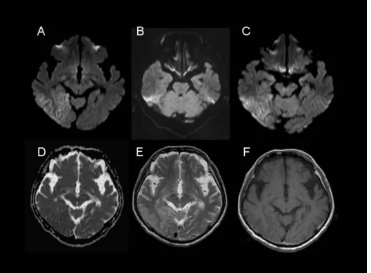 図 6.症例 4 の MRI.  A、FLAIR 画像、B, ADC マップ；C,DWI 画像；D, T1 強調画像.  左海馬に DWI 高信号病変を認めるが、ADC の低下はない。 
