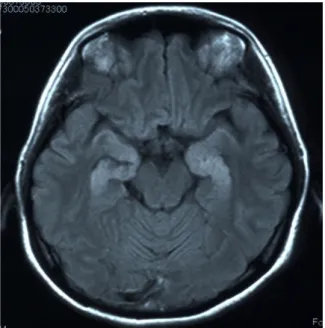 図 7.症例 18 の MRI.  A、DWI 画像、B,FLAIR 画像 両側海馬に DWI・FLAIR 高信号病変を認める。 