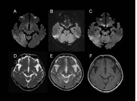 図 6.症例 4 の MRI.  A、FLAIR 画像、B, ADC マップ；C,DWI 画像；D, T1 強調画像.  左海馬に DWI 高信号病変を認めるが、ADC の低下はない。 