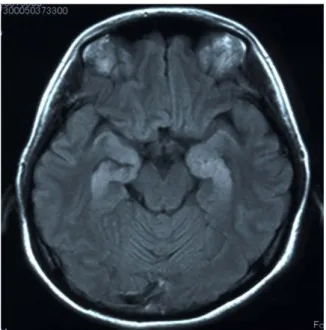 図 7.症例 18 の MRI.  A、DWI 画像、B,FLAIR 画像 両側海馬に DWI・FLAIR 高信号病変を認める。 