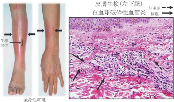 Fig. 2 に私たちが経験した，IFX が著効した NBD の頭部 MRI 画像の経過を示した 14） ． 血管炎症候群 血管炎症候群は血管炎を共通の病態として持つ，多種多様 な臨床像を呈する症候群の総称である．血管炎症候群の分類 は，チャペルヒル会議で Jennette らが報告した障害血管の太 さに基づく分類が広くもちいられている 15） ．臨床的に血管 炎は特異的な所見に乏しく，炎症に基づく臨床所見よりも， 血管壁の破壊による 2 次的な循環障害による臓器所見として 認知されることが多い．本稿に関す