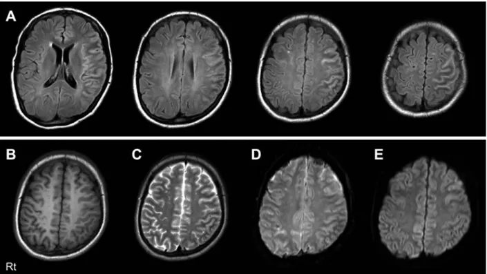 Fig. 2 Brain MRI (3 Tesla) 6 days after the onset of cerebral cortex encephalitis in a 17 years old patient.