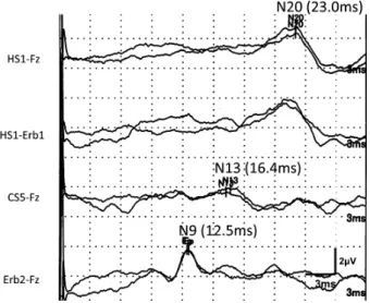 Fig. 2 Somatosensory evoked potential by stimulation of the right  median nerve.