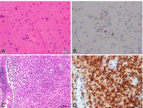Fig. 2 Histological pictures of first (A, B) and second (C, D) brain biopsy specimens.