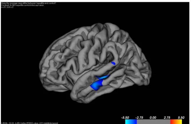 図 3 Vertex-wise analysis of cortical surface area in patients compared to  controls 