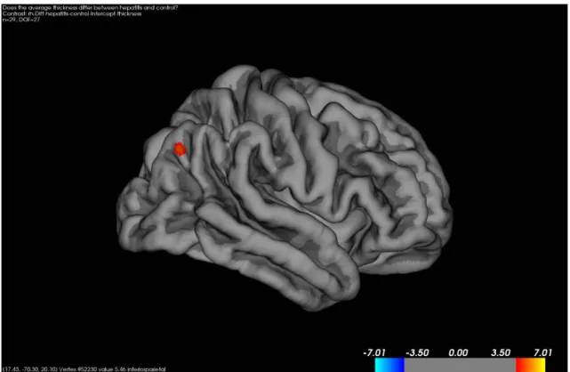 図 4   Vertex-wise analysis of cortical thickness in patients compared to  controls 