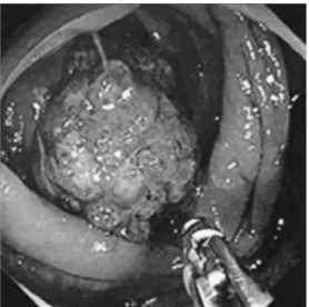 Fig. 2　Colonoscopy showed a 30-mm diameter tu- tu-mor in the ascending colon.