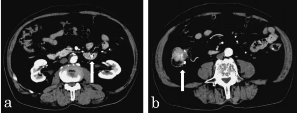 Fig. 4　ａ : The resected specimen showed a 23× ９ ×14mm tumor in the fourth portion of the  duodenum.