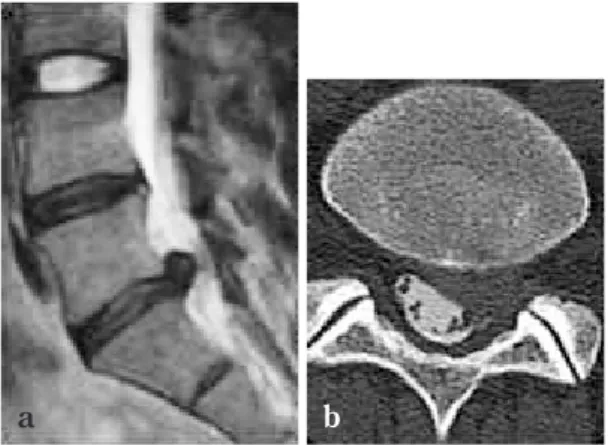 Fig.  1 Direction of disc hernia- hernia-tion