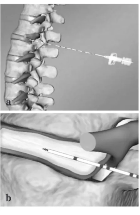 Fig.  4 Percutaneous nucleotomy （PN）