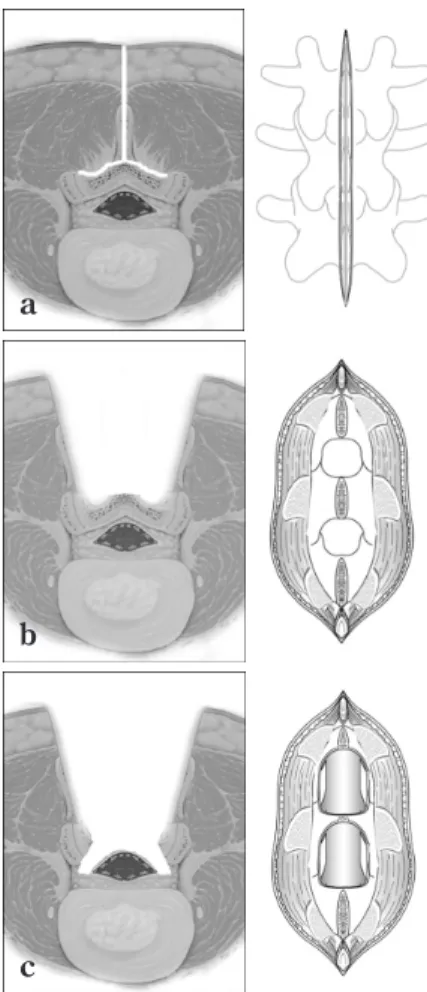 Fig.  10 Microsurgical trumpet laminectomy  a ：Spinous process splitting and muscle detachment.
