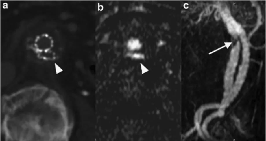 Fig 4. a, Plain computed tomography (CT) axial image. b, Superparamagnetic iron oxide (SPIO)-enhanced dynamic magnetic resonance imaging (MRI) axial image with subtraction