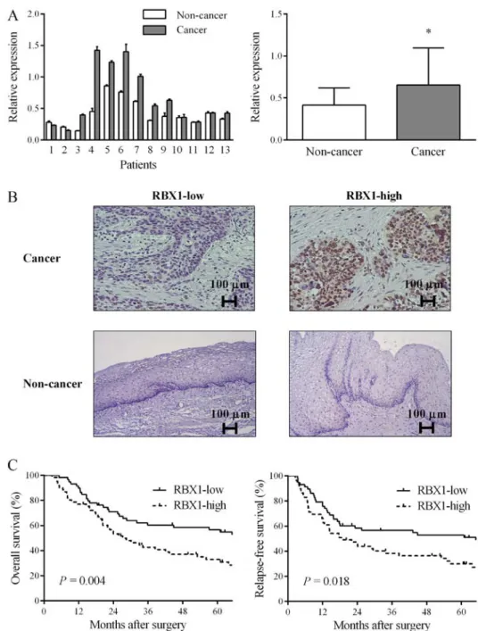 Figure 1. Clinical significance of RBX1 expression in EC. (A) Expression of RBX1 in cancer tissue was higher compared with non‑cancer tissue in 84.6% of  patients with EC
