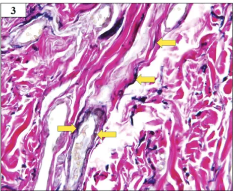 Fig. 3 EvG finding in deep layer of lesion 