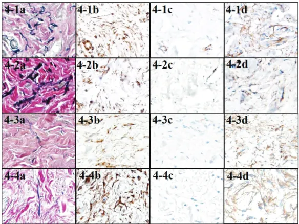 Fig. 4 EvG and immunohistochemical staining of cases in EF+ group 