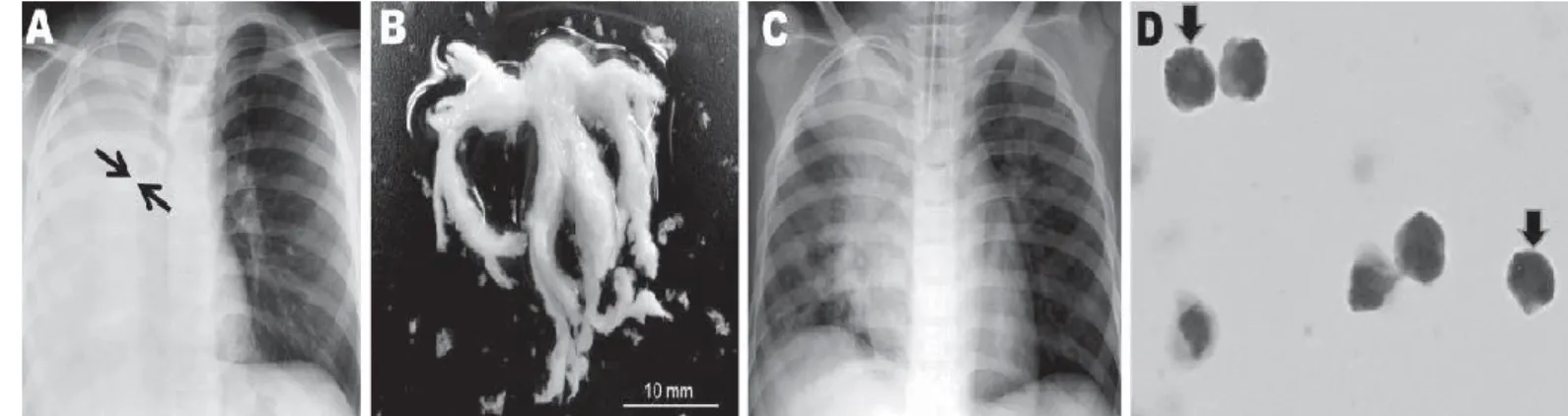 図  9 ： Plastic bronchitis の症例の X 線画像と粘液栓               A)入院時の胸部X線画像：右肺全体の無気肺と右主気管支の閉塞および左肺の過膨 張の所見がみられる．               B) 気管内吸引にて排出された粘液栓                C)入院2日目の胸部X線画像：右下肺の無気肺は消失している．                 D) 粘液栓の鏡顕像（ギムザ染色，1,000倍）：細胞の90%以上が好酸球であった． 