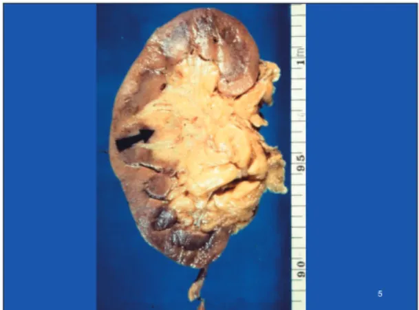Fig. 8. Multilocular clear cell renal cell carcinoma.