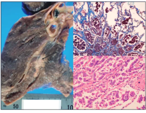 Fig. 19. Adenocarcinoma of the lung.