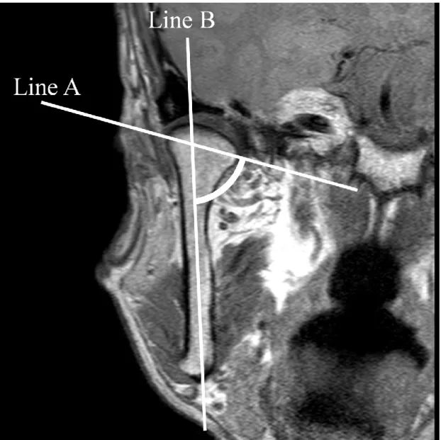 Fig. 2 Measurement of Angle 1 on a representative coronal slice image. Lines A and B  indicate the axes of the ramus and transversal condyle diameter, respectively