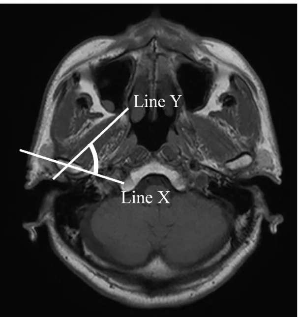 Fig. 3 Measurement of Angle 2 on a representative axial slice image. Lines X and Y indicate  the axes of the condyle and the direction of the lateral pterygoid muscle at the center of the  condyle, respectively