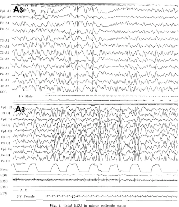 Fig.  4  Ictal  EEG  in  minor  epileptic  status