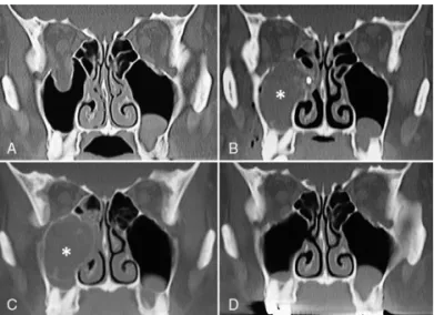 FIGURE 4. Clinical report. (A) A CT image at the time of injury. (B) CT image obtained 1 day postoperatively