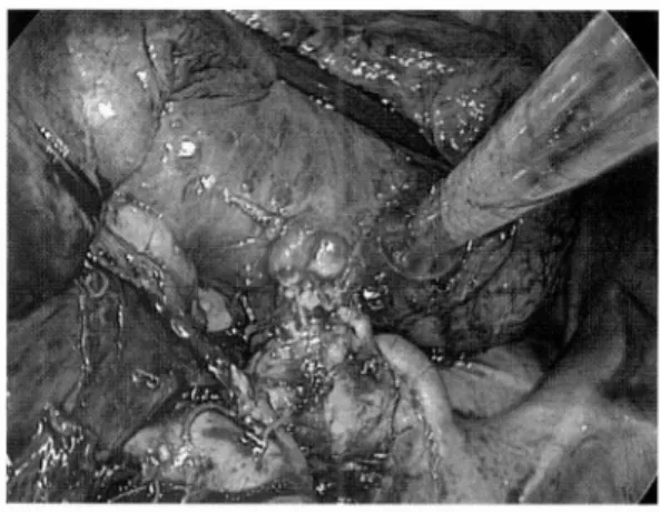 Fig.  1  Parenchymal  blue  dye  injected  surounding the  right  middle  lobe  tumor  is  visible,  as  well  as  a blue-stained  lymph  nodes  on  the  pulmonary artery