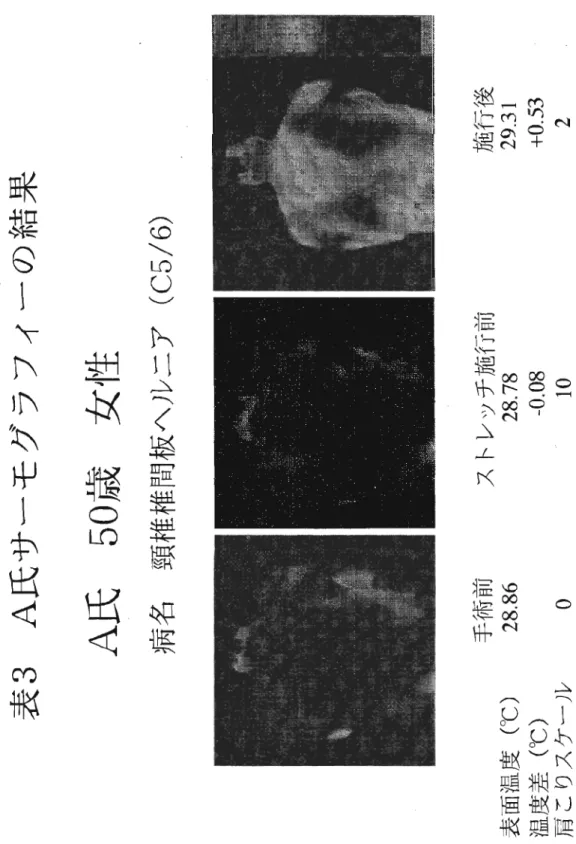 表 3 A 氏サーモグラフィーの結果 A 氏 50 歳 女 性 病名 頚椎椎間板ヘルニア ( C 5 / 6 ) 手術前 表面温度 CC) 2 8 . 8 6  温度差 CC) 肩こりスケール 0  ストレッチ施行前28.78 ‑0.08 10  施行後29.31 +0.53 2 