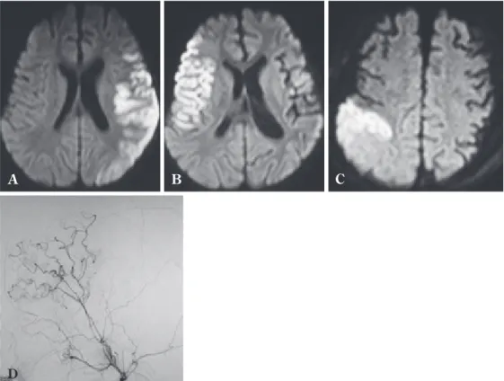 Fig.  2  A  2 year old boy presenting with cerebral infarction in the left and the right  middle cerebral artery （MCA）territories, respectively in two weeks  The left and the right superficial temporal artery MCA bypass with indirect procedures  were perfo