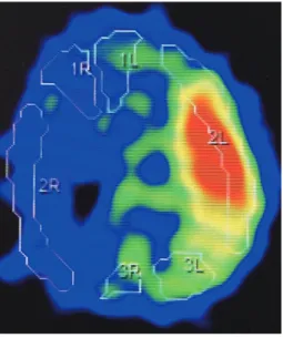 Fig.  3  A  37 year old woman of  moyamoya disease （Fig. 1）  Postoperative 123IMP SPECT  dem-onstrating severe hyperperfusion in the  left middle cerebral artery territory.