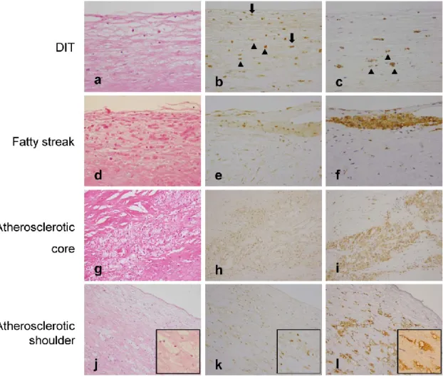Figure 4.    PPAR-γ protein expression in DIT, fatty streaks, and atheromatous  plaques