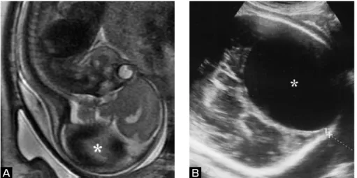 Fig. 1　 Antenatal  T2-weighted  MR  image  (A)  at  a  gestational  period  of  28  weeks  and  ultra-  sonogram of the head (B) at 35 weeks, indicating a huge venous pouch (asterisk) in the  left posterior portion of the fetal head.