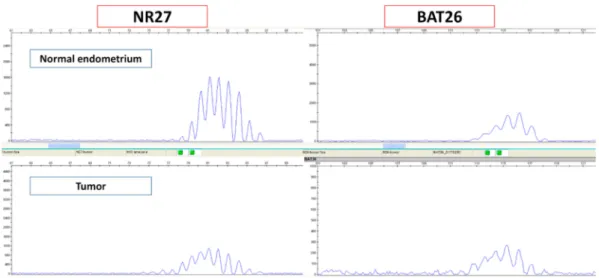 Figure 5. Cases that were evaluated as MSI by immunohistochemistry were further validated by MSI analysis.