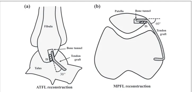 Figure 1. Schema of ATFL reconstruction (a) and MPFL reconstruction (b). The tendon grafts were pulled at angles of 30  and 60  , respectively