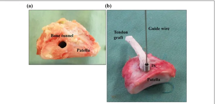 Figure 2. (a) Photograph of the patella and bone tunnel. (b) The fixing of the tendon graft using an IS