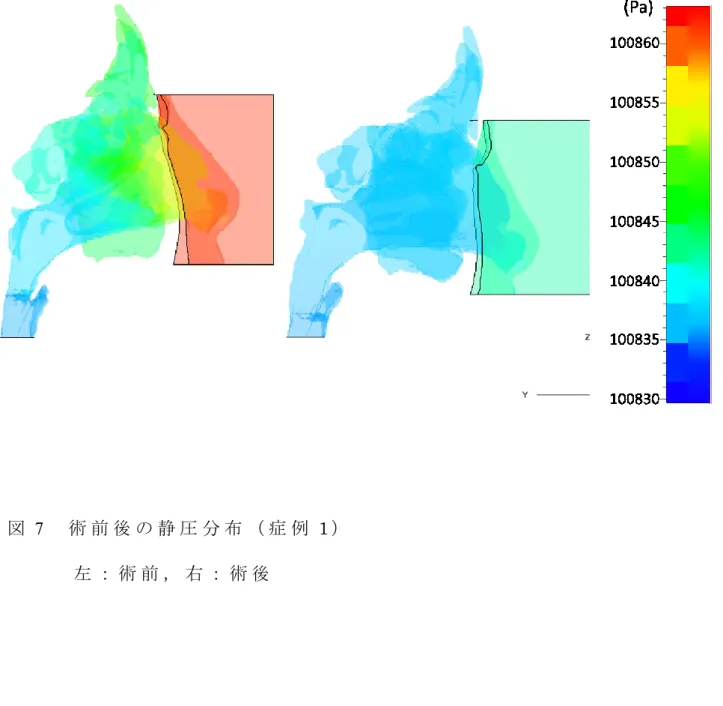 図 7   術 前 後 の 静 圧 分 布 （ 症 例 1 ） 左 ： 術 前 ， 右 ： 術 後