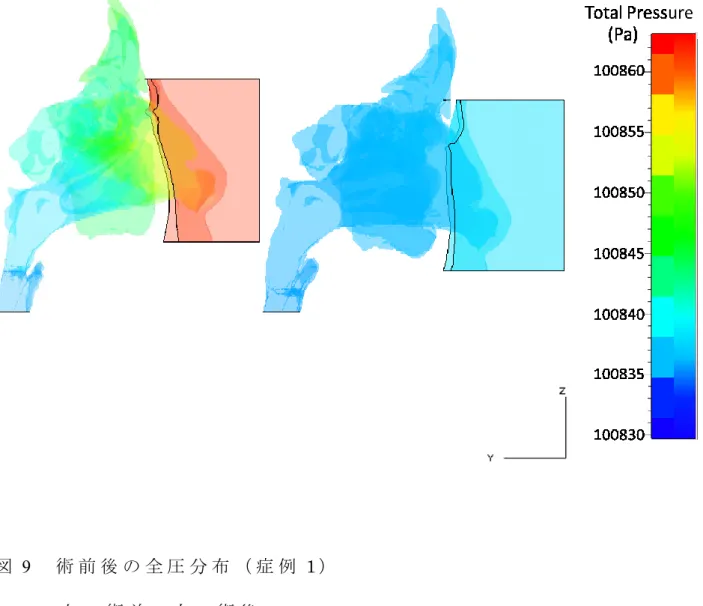 図 9   術 前 後 の 全 圧 分 布 （ 症 例 1 ） 左 ： 術 前 ， 右 ： 術 後