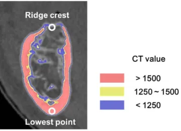 Fig. 2 Residual ridge crest and lowest point of the mandible 