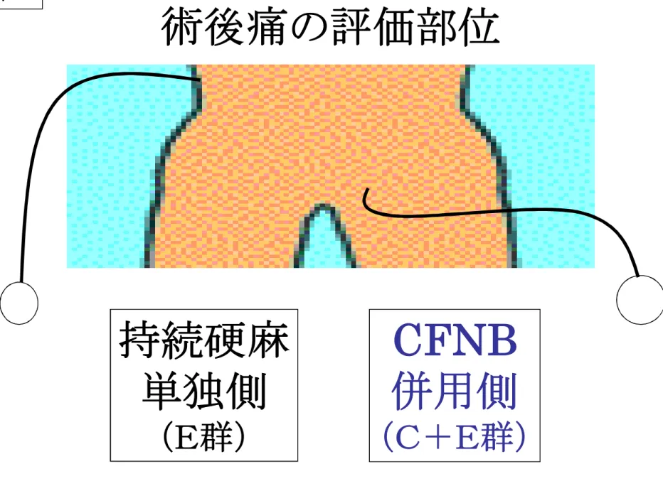 図 4 術後痛の評価部位 持続硬麻 単独側 （Ｅ群） CFNB 併用側 （Ｃ＋Ｅ群）