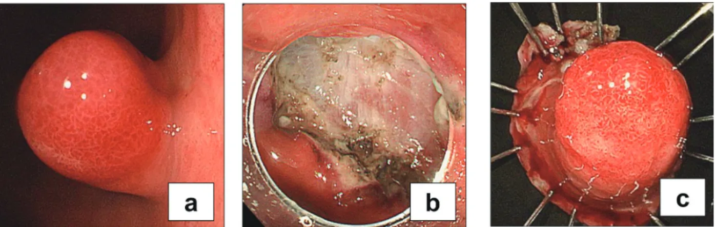 Fig. 4. a) Endoscopic images taken during endoscopic submucosal dissection, showing the healed ulcer on the tumor  side and the tumor, although it remained entirely reddish in color
