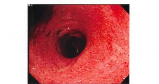 Fig. 1.  Sigm oi dscopy  showed  co nsecuti ve  abru pt mucosa,  sponta neo us bl eeding  and  mul tiple  deep  ulcers