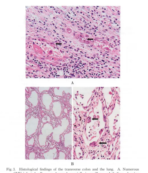 Fig. 3.  Histo log ica l  fin dings  of  the  transverse  colon  and  the  lung.  A.  Num erous  CMV  infected  cells  we re  observed  especia ll y  in  ca pillary  end othe lium, showing  CMV  coli tis  based  on  ulcerat ive  colitis