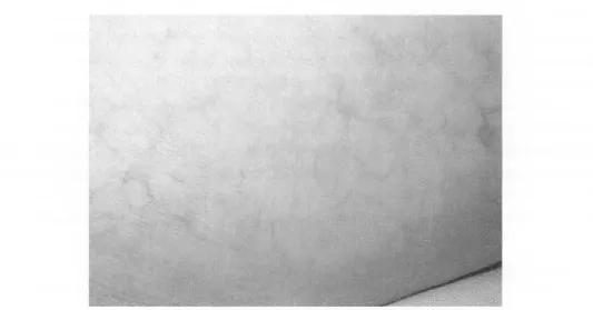 Fig .1.  Livedo  reticularis in  the  lower  portion  of  the  right  leg. 