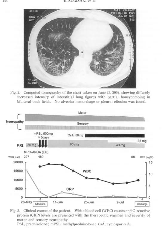 Fig. 2.  Computed  tomography of the chest taken on June  25,2002,  s how ing  diffusely  increased  intensity  of  interstitial  lung  figures  with  partia l  honeycombing  in  bilateral  back fie lds