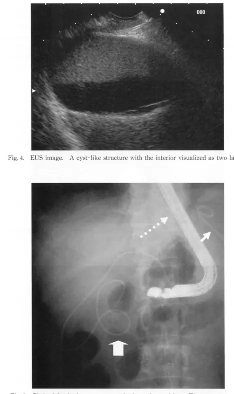 Fig. 4.  EUS  image .  A  cyst- like  st ructure  with  the  interi or  visua lized  as  two  layers