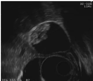 Fig. 2. Typical image of advanced gastric cancer obtained by  MR - ES.